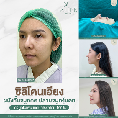 ALINE Clinic by หมอภูวิช ดึงหน้า เสริมจมูกโอเพ่น ตาสองชั้น โคราช