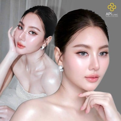 APi Clinic Surgery & Wellness เสริมจมูกเทคนิคเกาหลี by หมอต้น AF