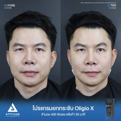 รีวิวยกกระชับ