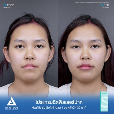 รีวิวฉีดฟิลเลอร์