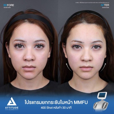 รีวิวยกกระชับใบหน้า
