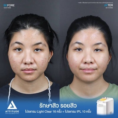 รีวิวรักษาสิว