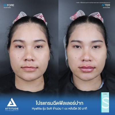 รีวิวฉีดฟิลเลอร์ปาก