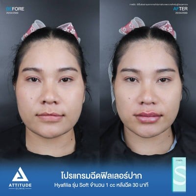 รีวิวฉีดฟิลเลอร์ปาก