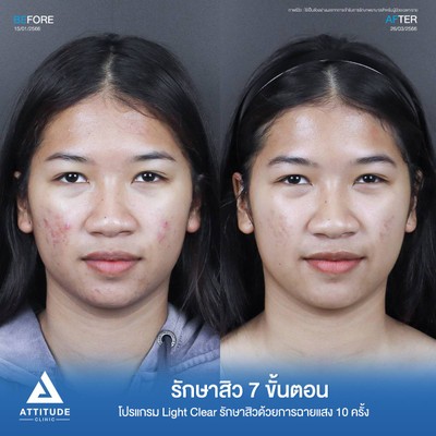 รีวิวรักษาสิว
