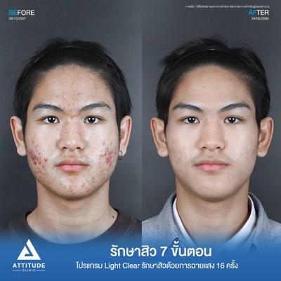 รีวิวรักษาสิว