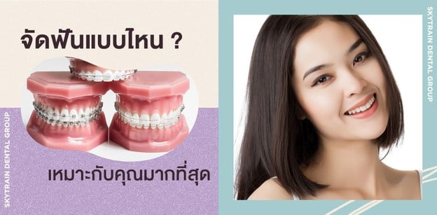 “จัดฟัน” แบบไหนเหมาะกับคุณมากที่สุด