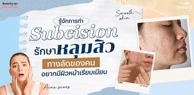 รู้จักการทำ Subcision รักษาหลุมสิว ทางลัดของคนอยากมีผิวหน้าเรียบเนียน