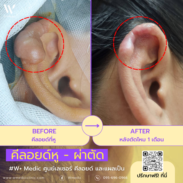 รีวิว ครบ 1 เดือนหลังตัดไหม แผลคีลอยด์หูดีขึ้นแค่ไหน! มาดูกัน ที่ W⁺ Medic Clinic 🎉