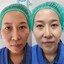 Double P Clinic ศัลยกรรมตาสองชั้น ตัดถุงไขมันใต้ตา เสริมจมูก เสริมคาง ตัดไขมันกระพุ้งแก้ม ดูดไขมัน กรุงเทพ