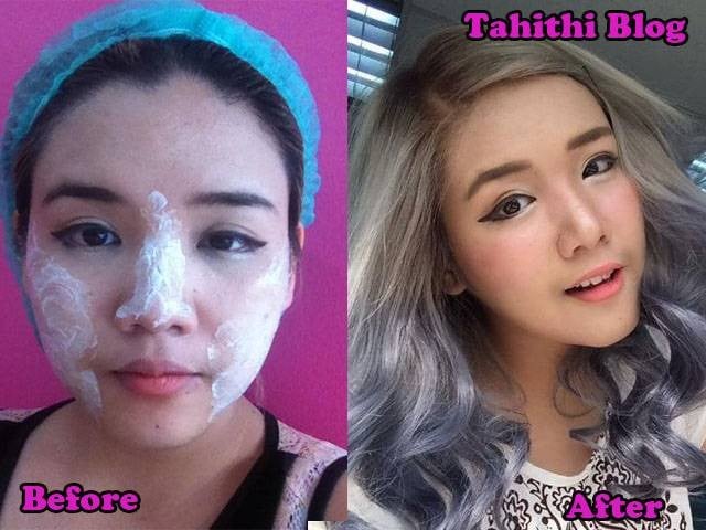 Before-After ประมาณ 1 เดือน หน้ากระชับขึ้นมากกก เห็นเป็นรูปหน้ามากขึ้น ชอบมากกก 