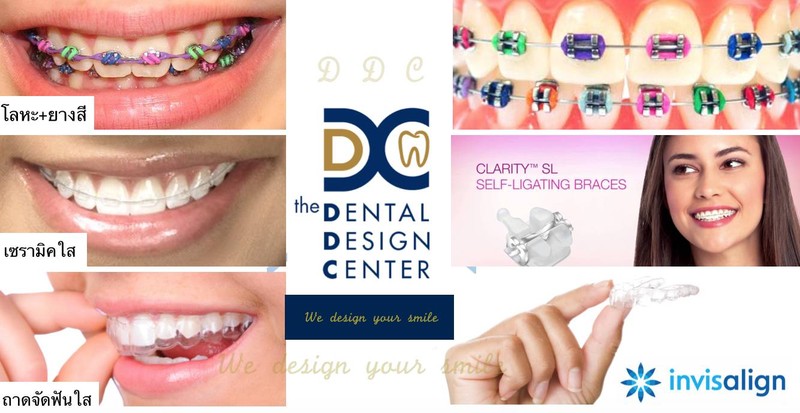 จัดฟันแบบยางสี จัดฟันแบบใส Invisalign จัดฟันแบบเซรามิค จัดฟันระบบ Damon พัทยา