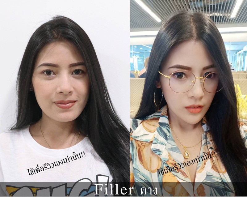 ปรับรูปหน้า ให้เป็น V-shape ด้วย Filler คาง