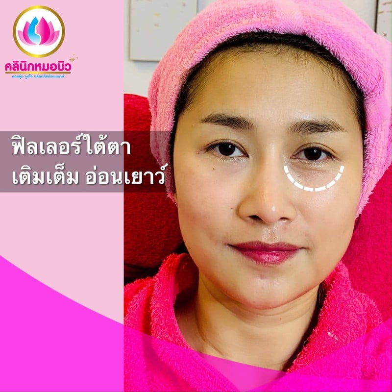 ลดใต้ตาหมองคล้ำ หน้าเด็กลง 10ปี