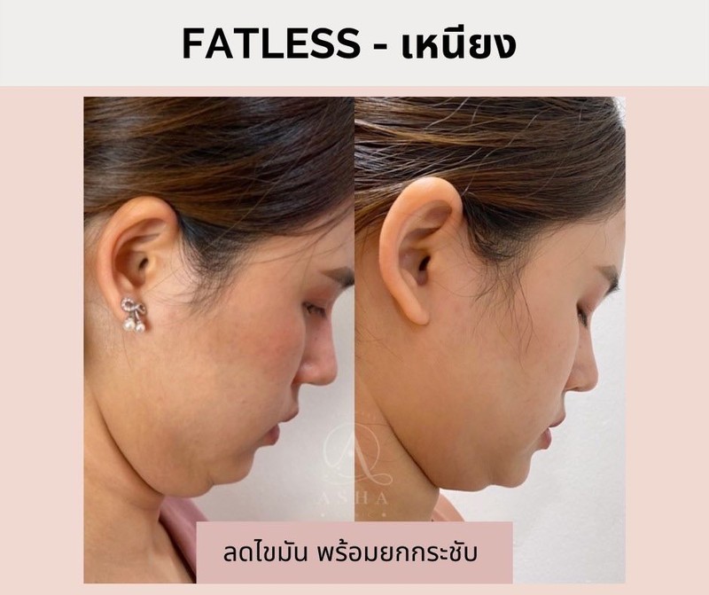 กำจัดแก้ม เหนียง ไขมันสะสม สลายไขมันใบหน้า อย่างปลอดภัย ปรับรูปหน้าทันใจ