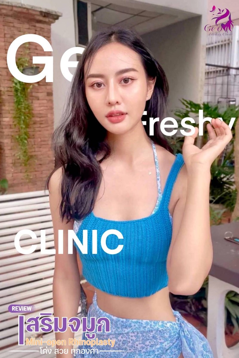 รีวิวเสริมจมูก By Ge'o freshy Clinic สาขาฝาง