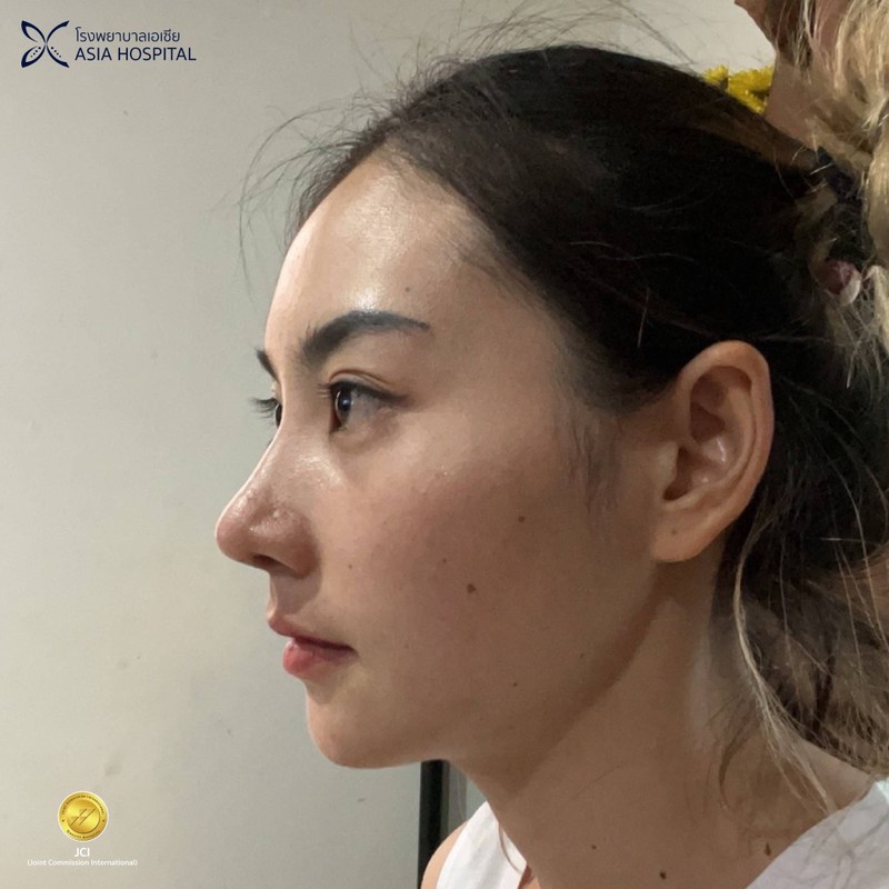 Rhinoplasty /แก้จมูก 