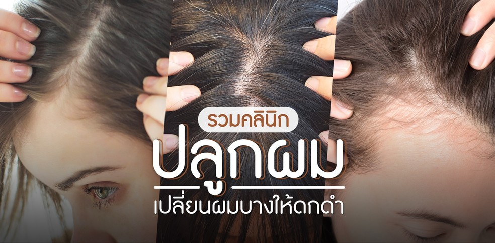 รวมคลินิกปลูกผม เปลี่ยนผมบางให้ดกดำ